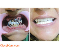 Dental Veneers Cost in Chennai