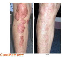 AROGYAM PURE HERBS KIT FOR PSORIASIS