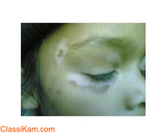 AROGYAM PURE HERBS KIT FOR VITILIGO