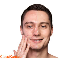 Rediscover Your Radiance with Expert Facial Fillers Treatment