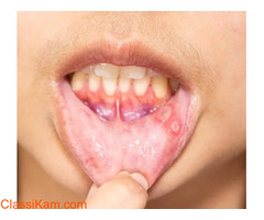 Impactful Homeopathic Treatment For Mouth Ulcers