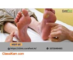 Effective Diabetic Foot Ulcer Treatment in Kolkata